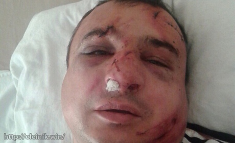 Фотофакт: В Киеве избили луганского сепаратиста Арсена Клинчаева